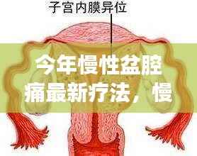 今年慢性盆腔痛最新疗法详解,步骤指南与初学者进阶教程