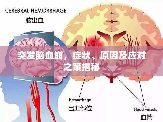 突发脑血崩,症状、原因及应对之策揭秘
